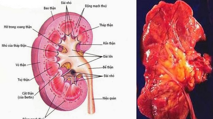 Viêm cầu thận cấp thuộc phạm vi chứng phù thũng (thể dương thủy) của y học cổ truyền.